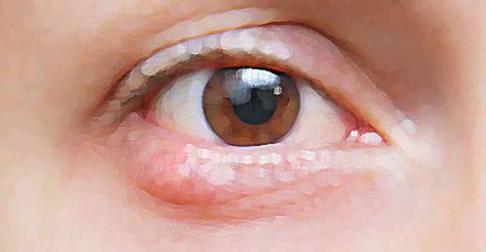 Orzaiolo: la fastidiosa infiammazione batterica dell’occhio