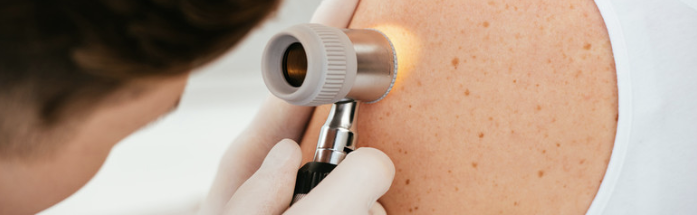 Prevenire e guarire il melanoma: si muore sempre meno