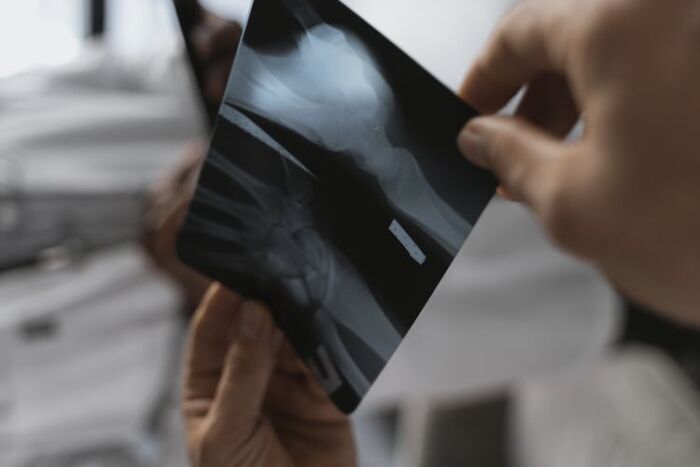 Il progetto GAP: un passo avanti nella prevenzione delle fratture ossee