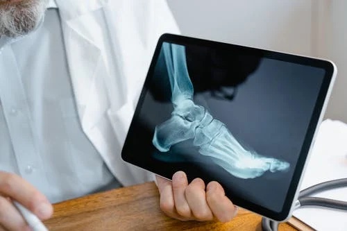 Fratture: i migliori alimenti che aiutano a rinforzare le ossa