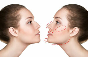 Profiloplastica liquida: rimodellare il profilo del viso senza bisturi