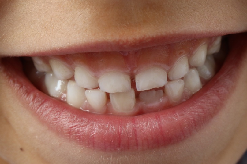 Morso inverso, quando i denti inferiori si trovano davanti a quelli superiori