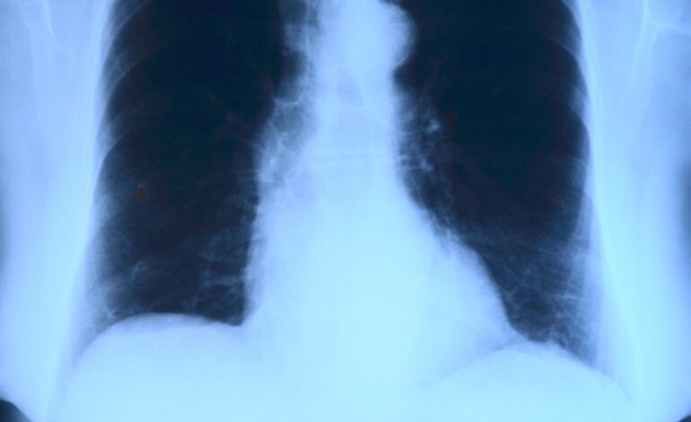 adenocarcinoma polmonare