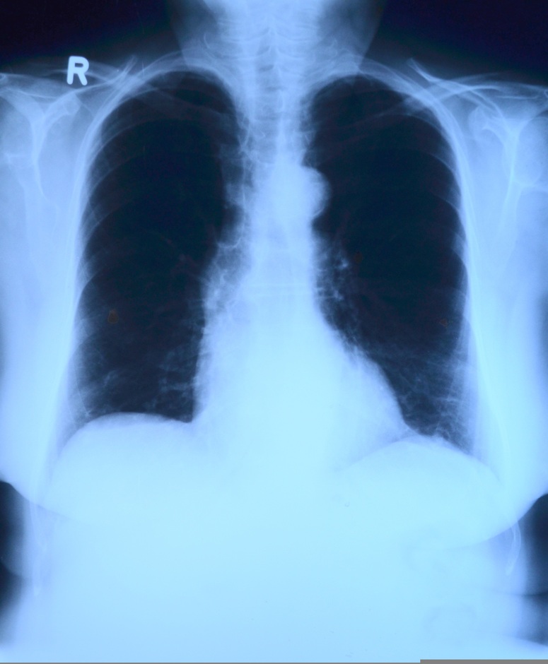 Papa Leone XIV, cos’è l’adenocarcinoma polmonare e quali sono i sintomi